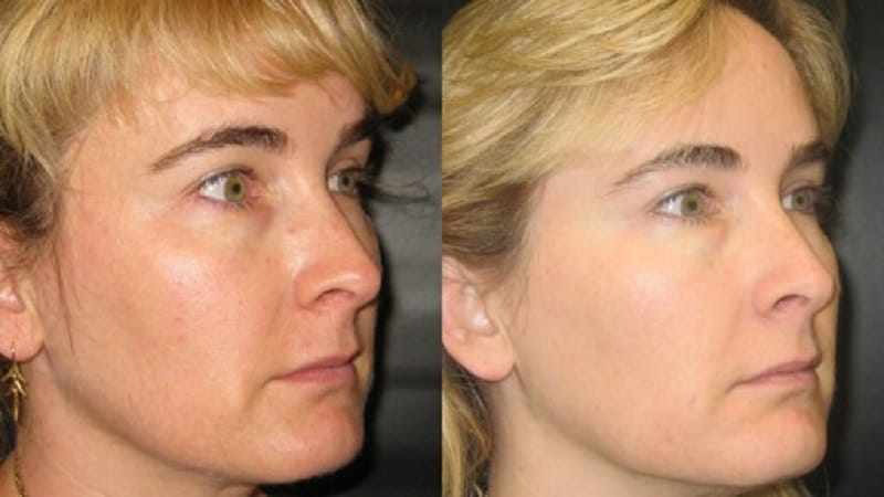 Ultherapy before and after - oblique view