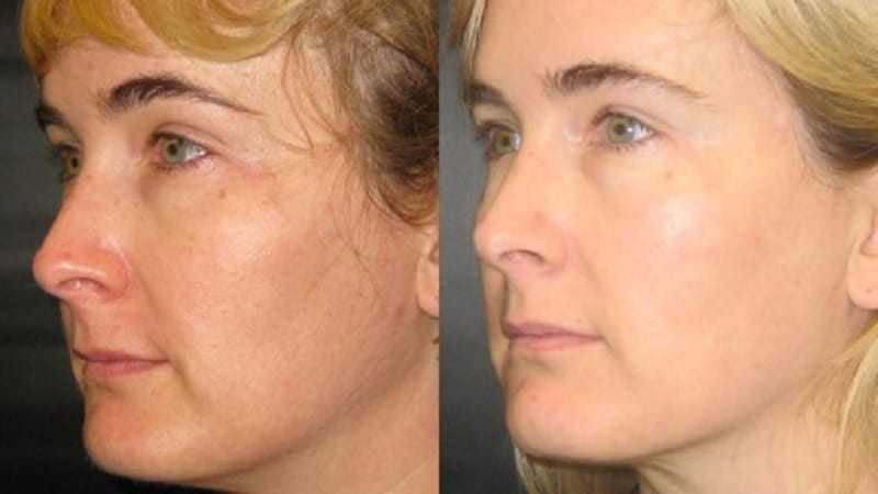 Ultherapy before and after - oblique view