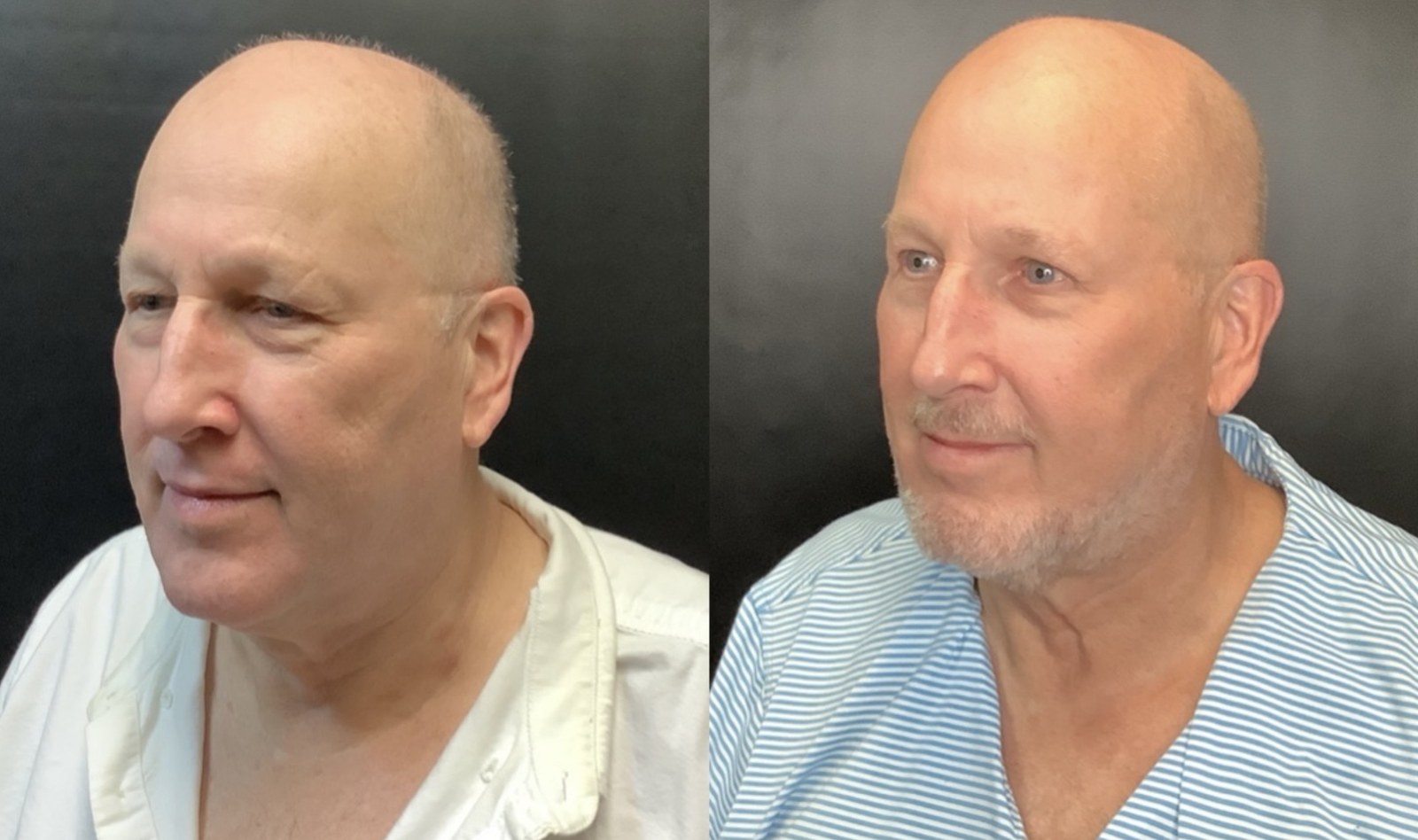 Ultherapy before and after - oblique view