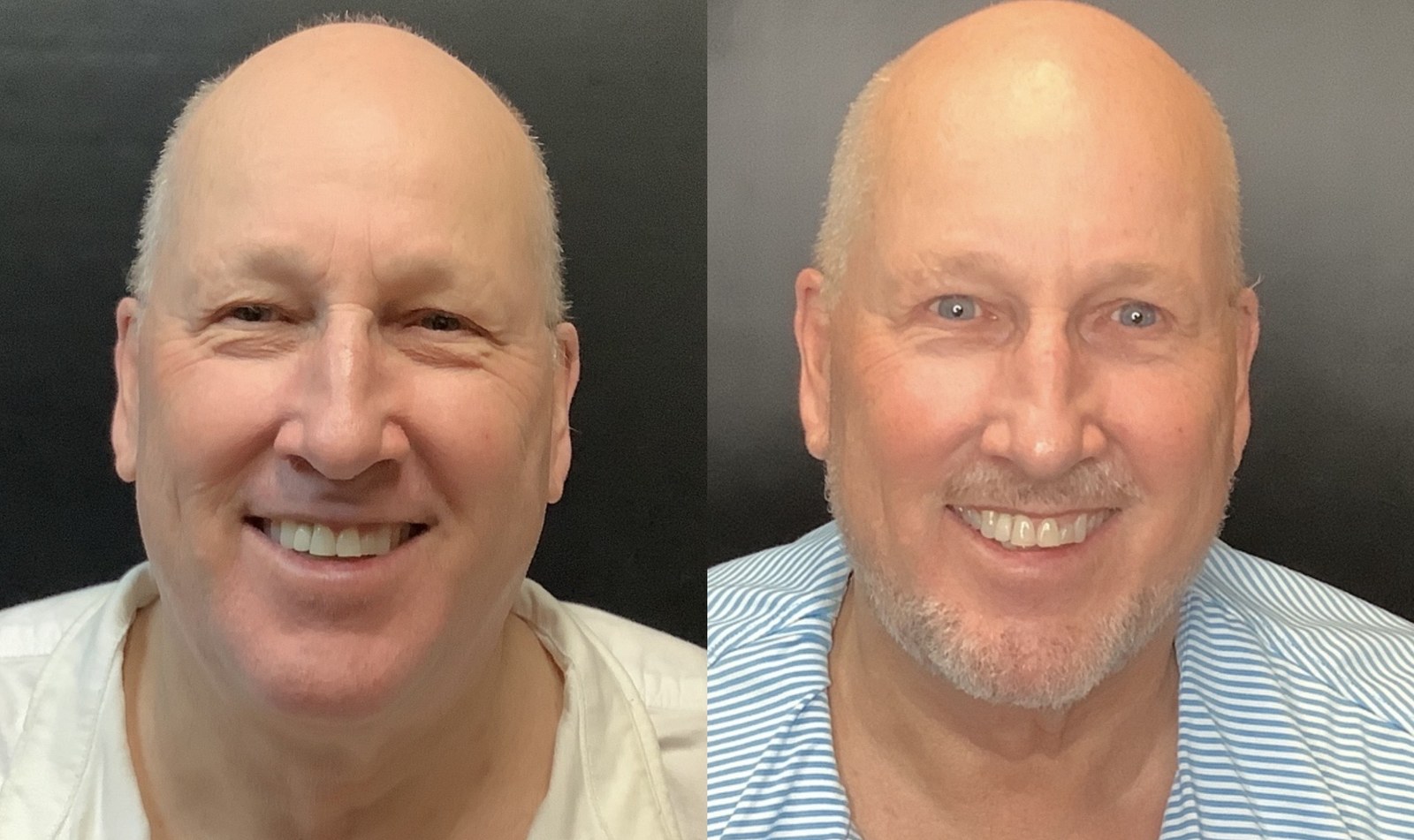 Ultherapy before and after - frontal view