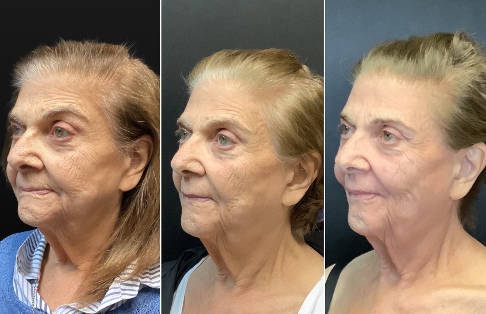UltraClear 3D MIRACL before and after - oblique view