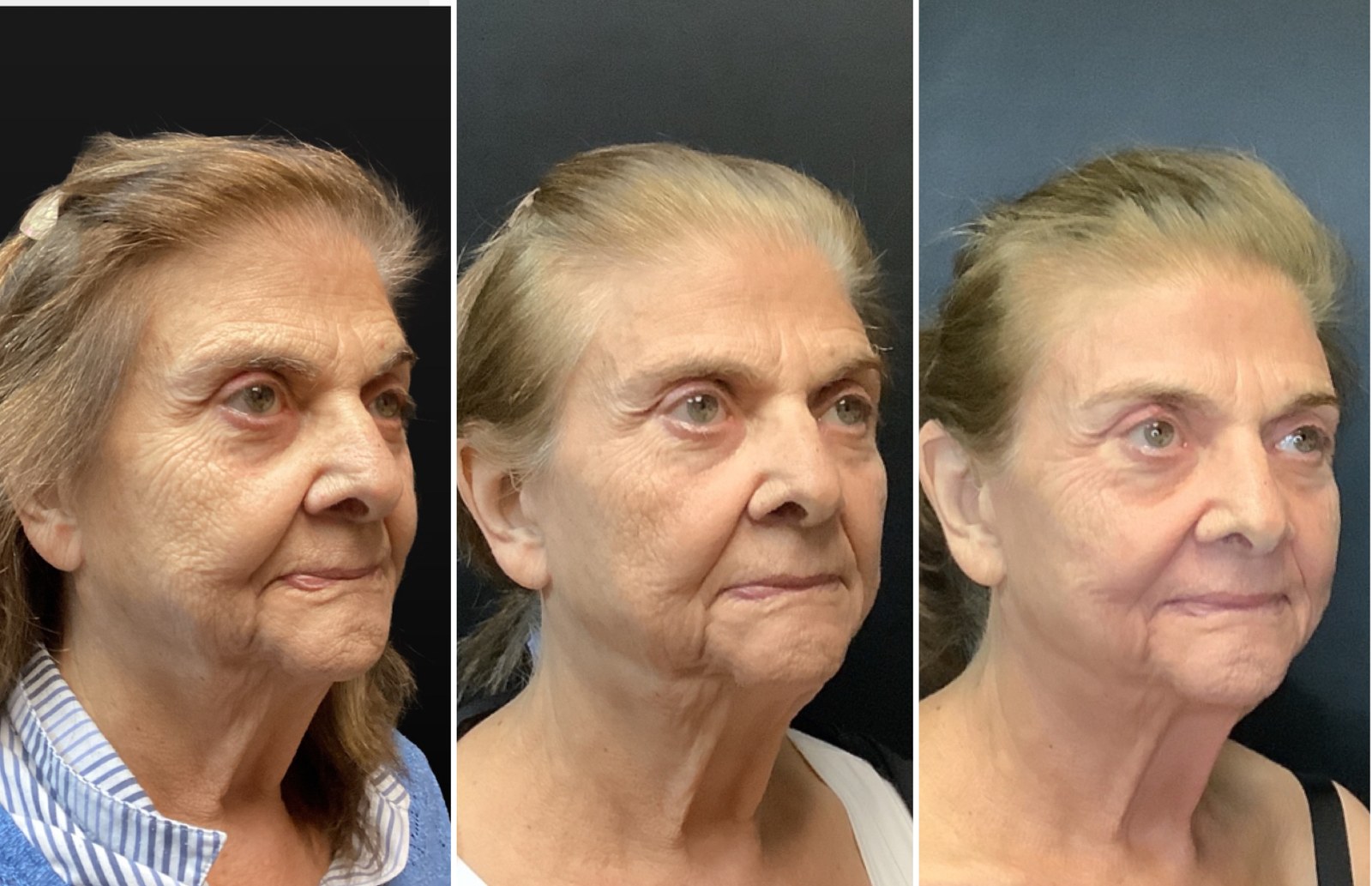 UltraClear 3D MIRACL before and after - oblique view
