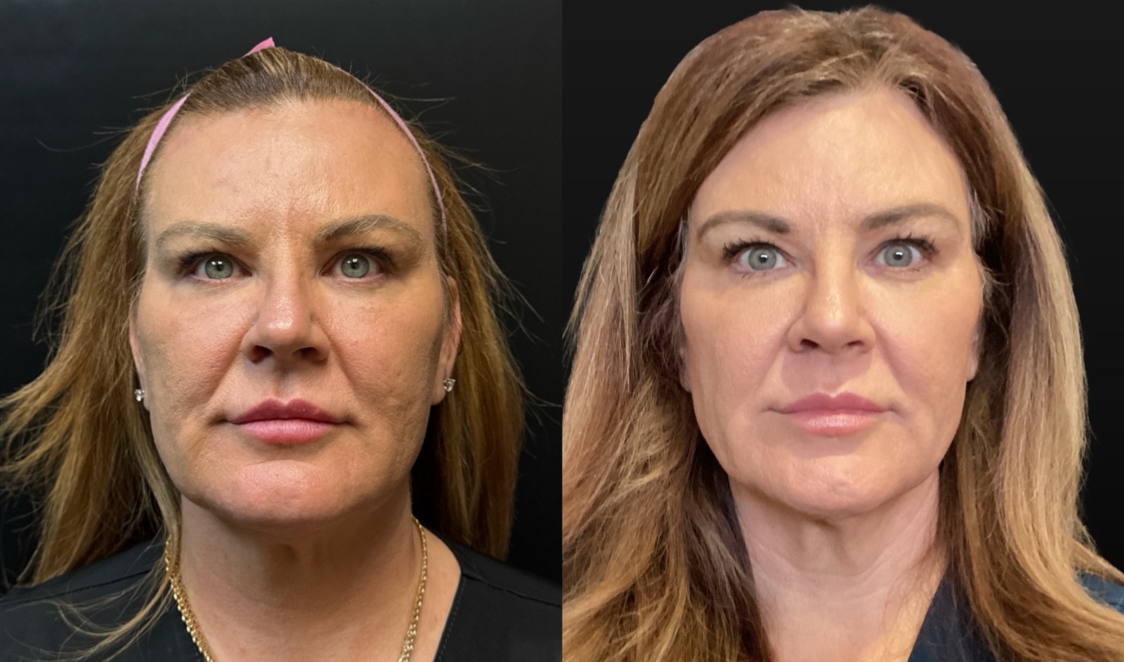 UltraClear 3D MIRACL before and after - frontal view