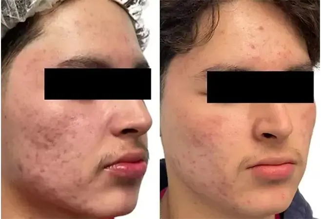 AquaFirmeXS before and after - oblique view