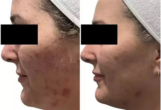 AquaFirmeXS before and after - profile view