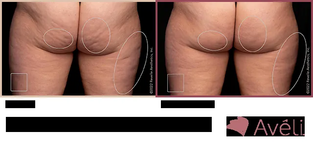 Avéli for Cellulite before and after - posterior view