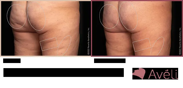 Avéli for Cellulite before and after - oblique view