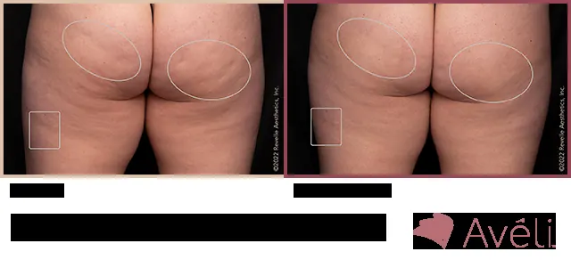 Avéli for Cellulite before and after - posterior view