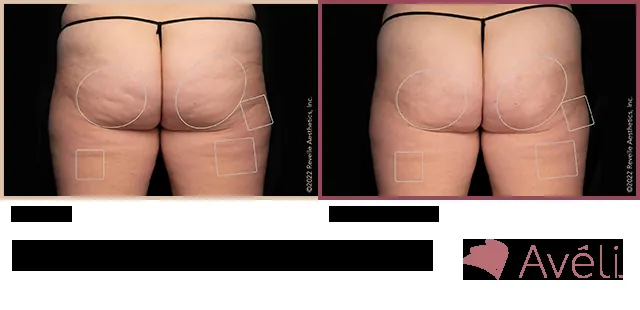 Avéli for Cellulite before and after - posterior view