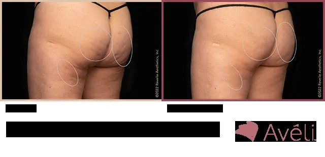 Avéli for Cellulite before and after - oblique view