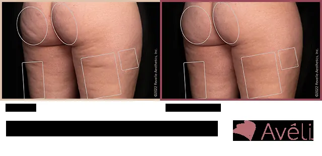 Avéli for Cellulite before and after - oblique view
