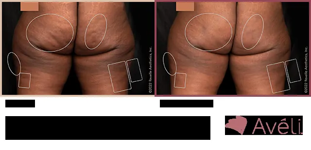 Avéli for Cellulite before and after - posterior view