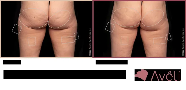 Avéli for Cellulite before and after - posterior view