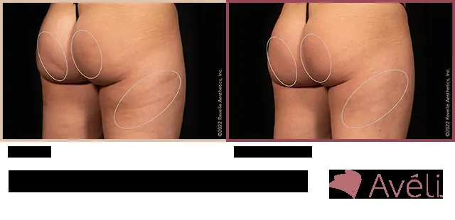 Avéli for Cellulite before and after - oblique view