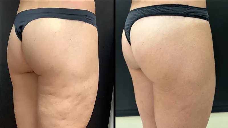 Avéli for Cellulite before and after - oblique view