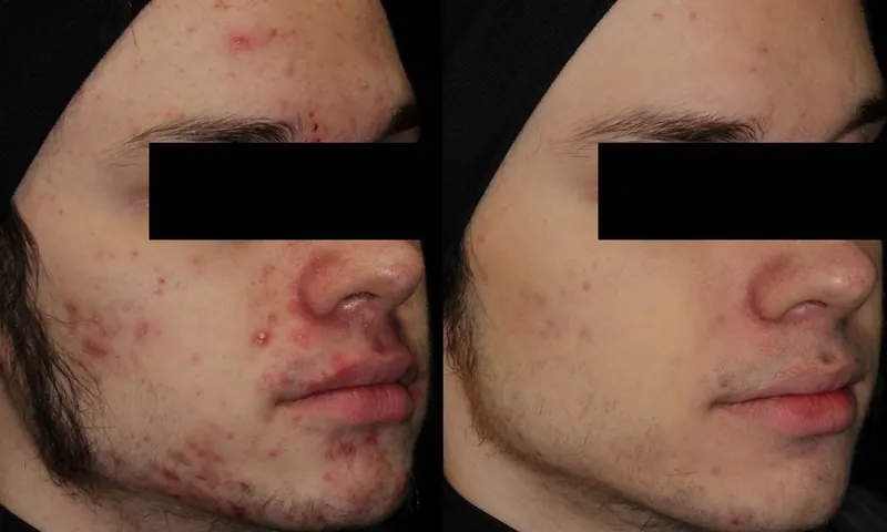AviClear Acne Treatment before and after - oblique view
