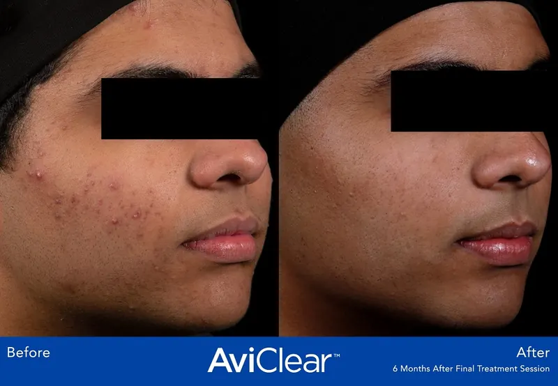 AviClear Acne Treatment before and after - oblique view