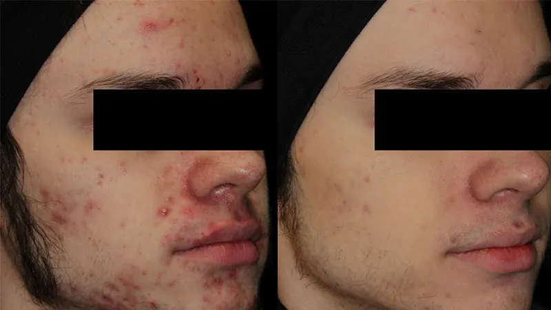 AviClear Acne Treatment before and after - oblique view