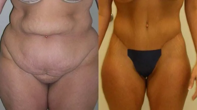 Body Lift before and after - frontal view