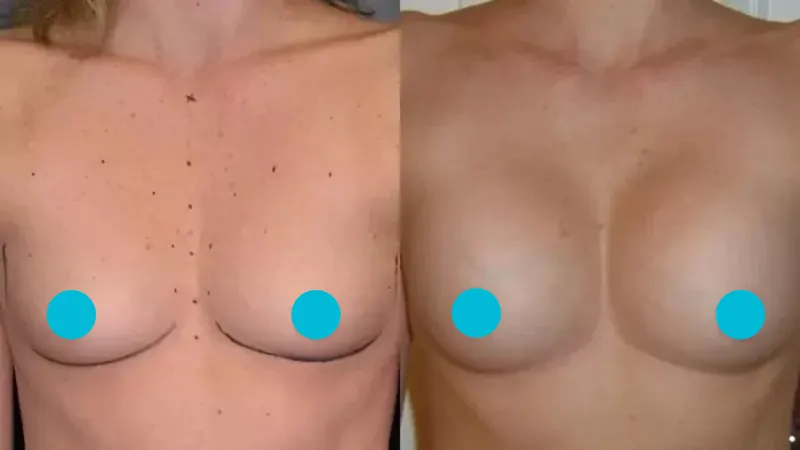 Breast Augmentation before and after - frontal view