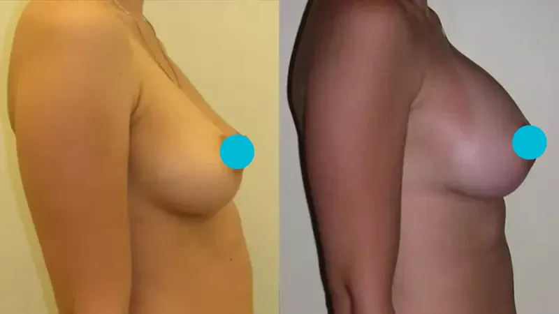 Breast Augmentation before and after - profile view