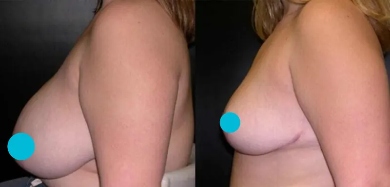 Breast Reduction before and after - profile view
