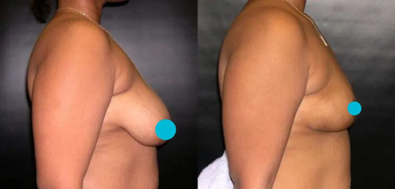Breast Reduction before and after - profile view