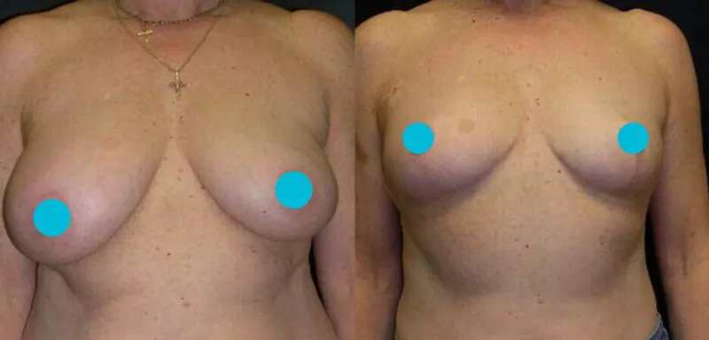 Breast Reduction before and after - frontal view