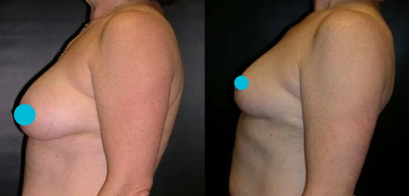 Breast Reduction before and after - profile view