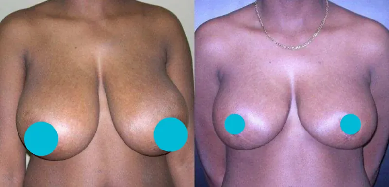 Breast Reduction before and after - frontal view