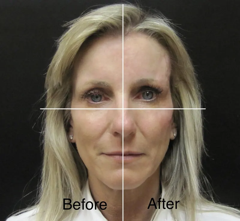Botox before and after - frontal view