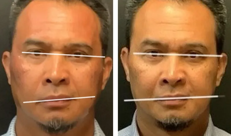 Juvéderm Family of Fillers before and after - frontal view