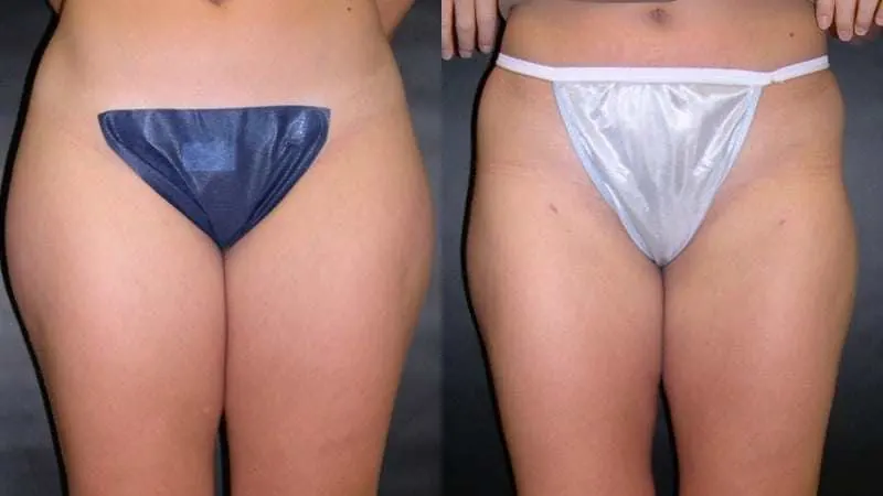 Liposuction before and after — Front view