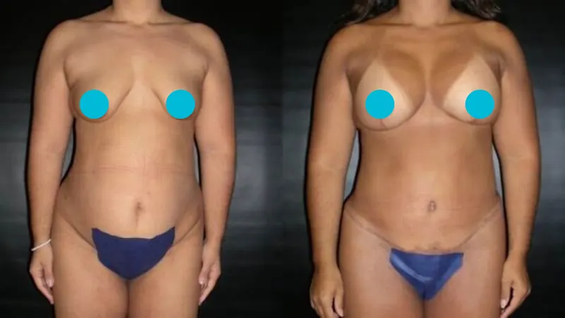 Mommy Makeover before and after - frontal view