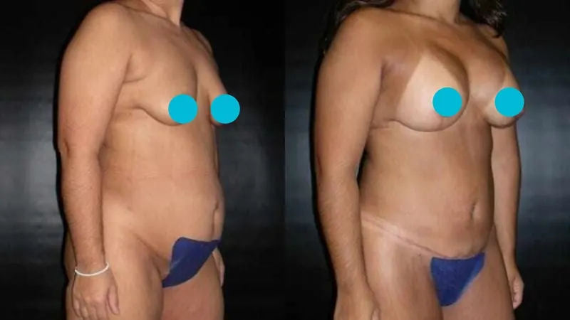Mommy Makeover before and after - oblique view