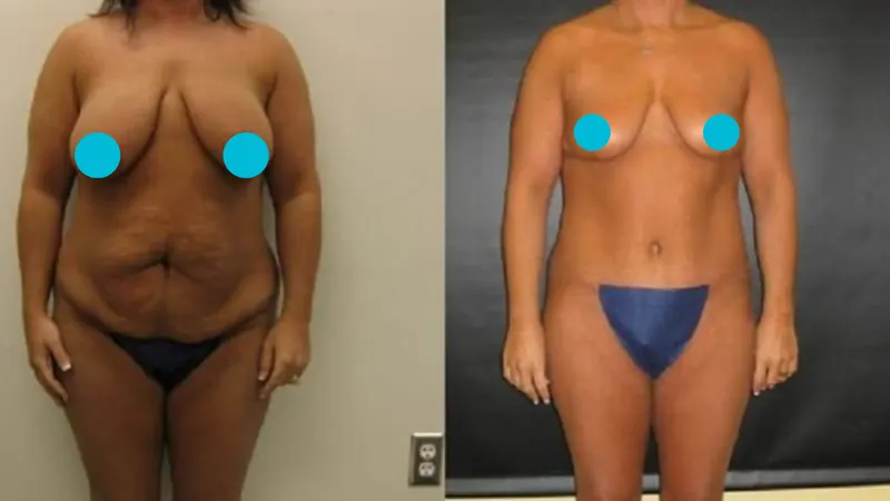 Mommy Makeover before and after - frontal view