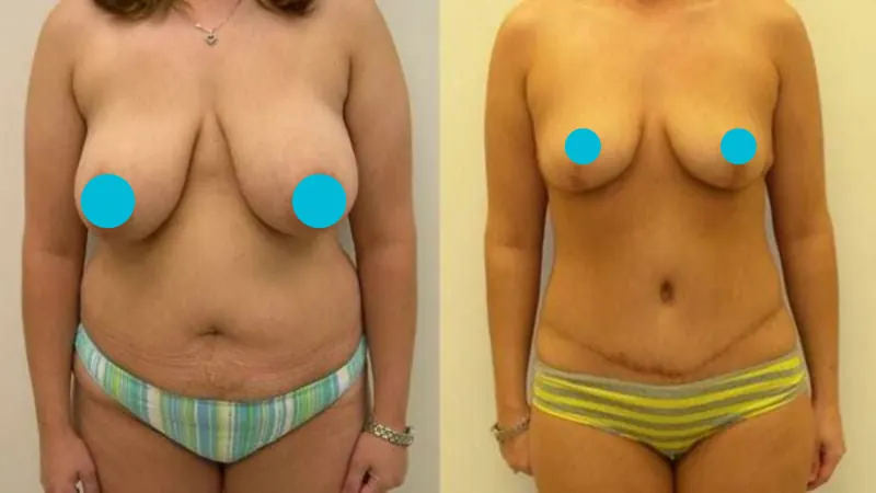 Breast Reduction before and after - frontal view