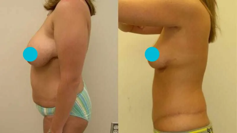 Breast Reduction before and after - profile view