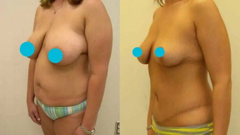 Breast Reduction before and after - oblique view