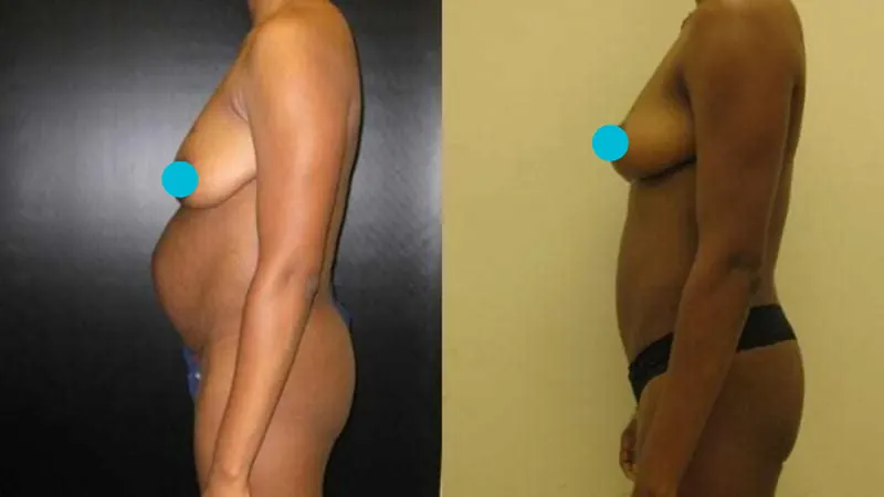 Mommy Makeover before and after - profile view