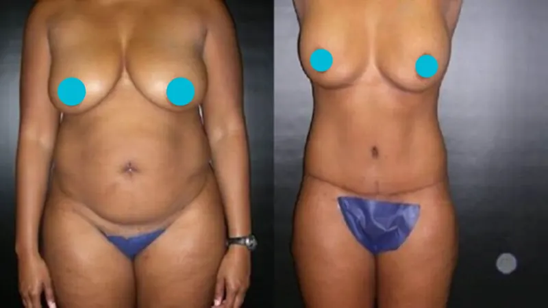 Mommy Makeover before and after - frontal view
