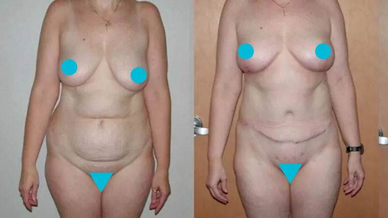 Breast Reduction before and after - frontal view