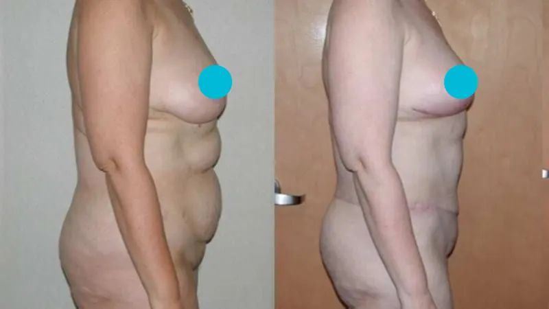 Breast Reduction before and after - profile view