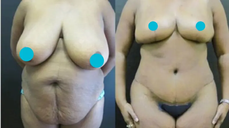 Mommy Makeover before and after - frontal view