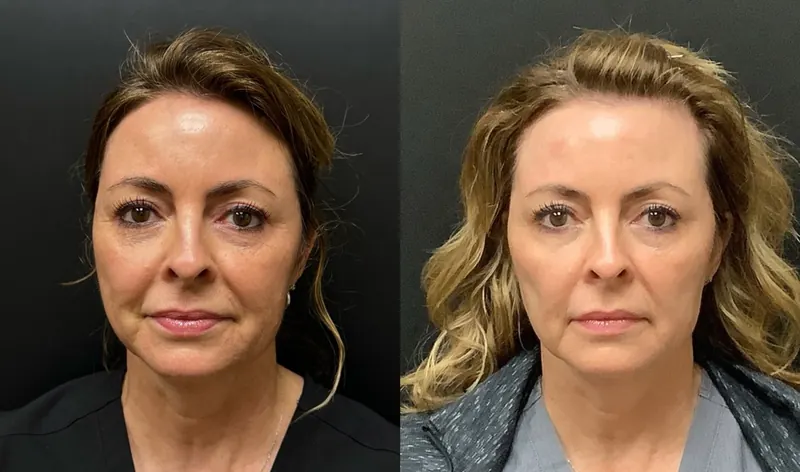 Radiesse before and after - frontal view