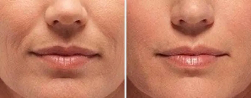 Radiesse before and after - frontal view