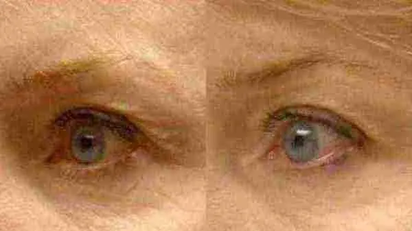 ThermiSmooth before and after - oblique view