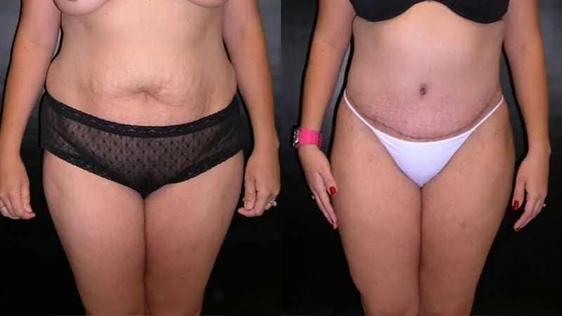Body Lift before and after - frontal view