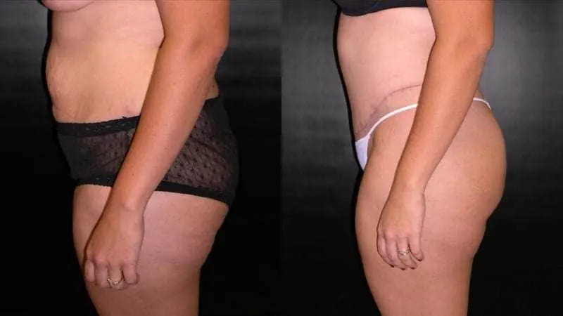 Body Lift before and after - profile view