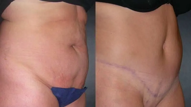 Tummy Tuck before and after — Angled view